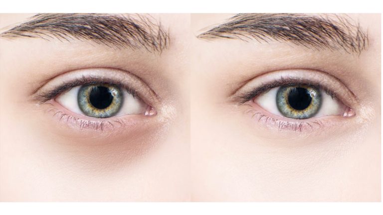 Do Computer Glasses Reduce Dark Circles